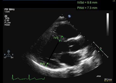 redGen&#39;s story :: Echocardiography